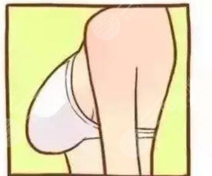 水滴形隆胸怎么樣？看看我的前后對比果圖片就知道了~
