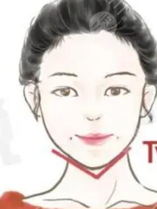 人造酒窩,整形,手術(shù),恢復(fù),過程,前后,果,對比圖