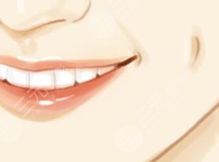 人造酒窩,手術(shù),恢復,過程,前后,果,對比,圖片,案例,分享