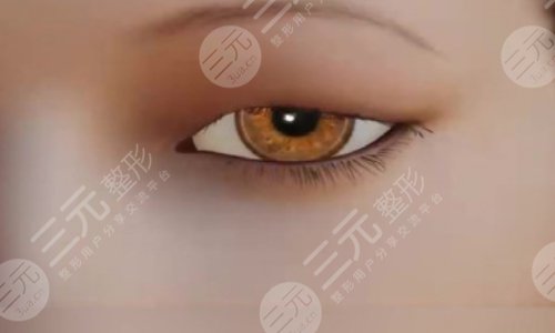 割雙眼皮后1-7天恢復圖