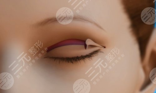 割雙眼皮后1-7天恢復圖