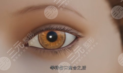 割雙眼皮后1-7天恢復圖