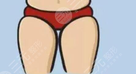 大腿吸脂減肥后恢復(fù)過(guò)程_真實(shí)案例分享
