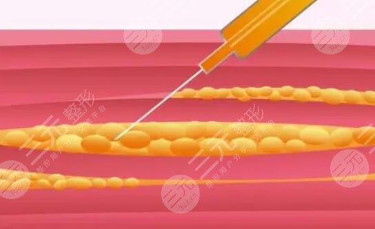 大腿吸脂減肥后恢復(fù)過(guò)程_真實(shí)案例分享