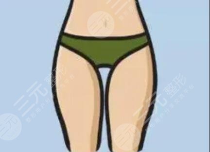大腿吸脂減肥后恢復(fù)過(guò)程_真實(shí)案例分享