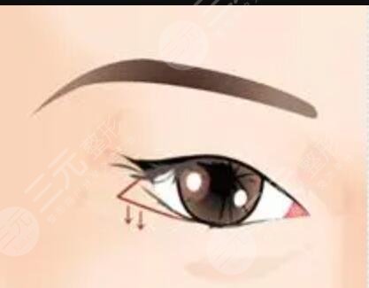 趙成利雙眼皮修復術前