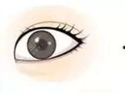 雙眼皮修復整形手術過程