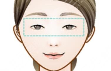 開眼角手術(shù)失敗修復(fù)價(jià)格和案例圖片