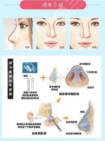 硅膠假體隆鼻