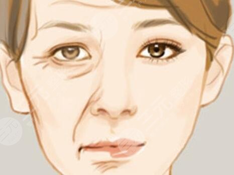 伊w蘭去皺果怎么樣？伊w蘭去皺術(shù)后對比照1