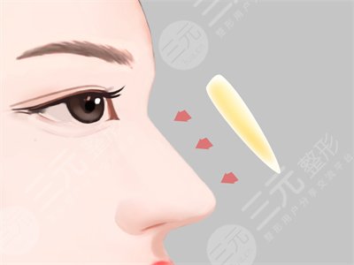 成都素美李建剛隆鼻果怎么樣？附案例真實反饋