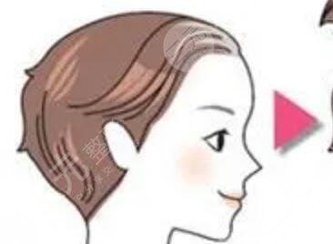 成都艾米麗醫(yī)院植發(fā)怎么樣？發(fā)際線果對(duì)比分享