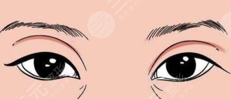 說(shuō)起我的經(jīng)歷我是一萬(wàn)個(gè)后悔,在此我要將“整形去正規(guī)醫(yī)院”這句話寫(xiě)在開(kāi)頭,說(shuō)起我的雙眼皮手術(shù)失敗,很大的原因還是因?yàn)橄胧″X輕信了不正規(guī)美容診所