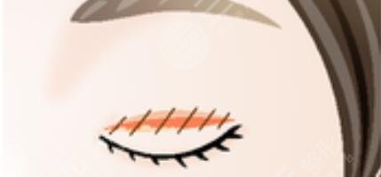 成都艾米麗眼部整形怎么樣？潘宏偉雙眼皮修復案例分享