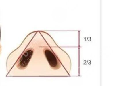 廈門思明薇格整形技術(shù)好不好？自體隆鼻果對(duì)比