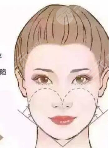 蘇州美萊整形水平怎么樣？自體面部填充變美日記分享