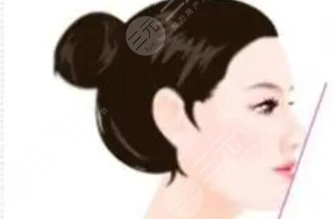 金華維多利亞整形好不好？來看妹子自體隆鼻術(shù)后果對(duì)比