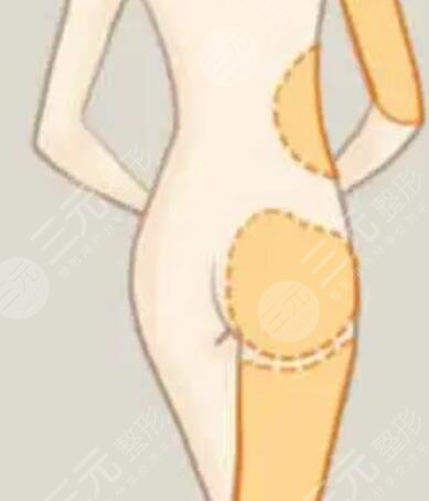 溫州星范吸脂貴不貴？誠(chéng)享吸脂瘦腿術(shù)后恢復(fù)過(guò)程