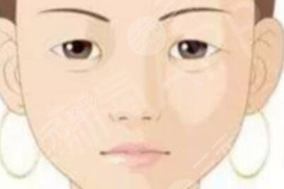埋線雙眼皮7天恢復(fù)照片