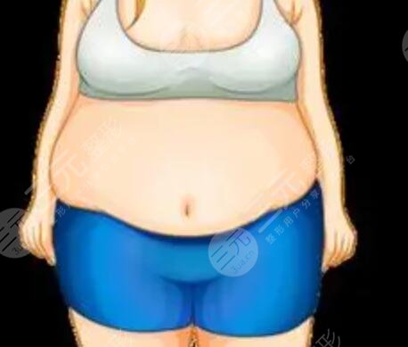 吸脂真人案例 吸脂恢復(fù)果對(duì)比