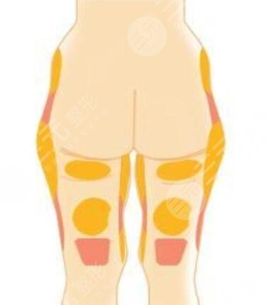 抽脂能瘦嗎 大腿吸脂后恢復(fù)案例