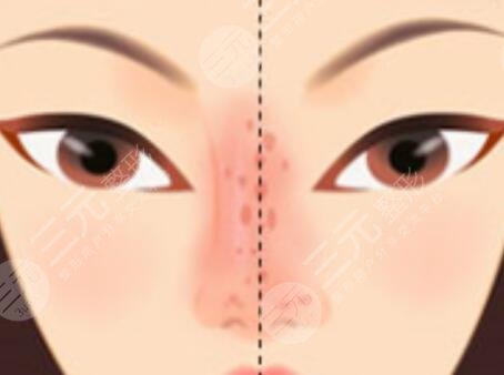 [種草]中山二院張金明案例：隆鼻失敗修復(fù)，重新?lián)碛辛Ⅲw感~