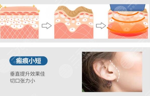 拉皮手術(shù)術(shù)后怎么護(hù)理？