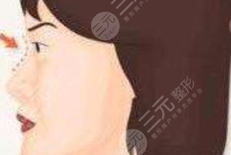 薛克墘做鼻子恢復(fù)期