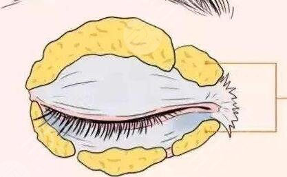 開(kāi)外眼角前后對(duì)比