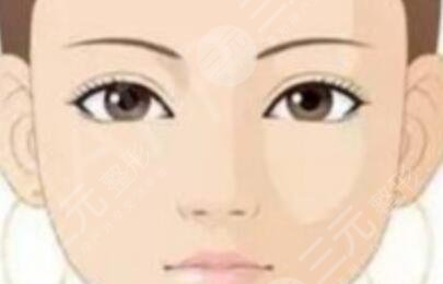 唐山金榮整形醫(yī)院切開雙眼皮案例圖