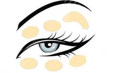 范希玲扇形雙眼皮案例圖