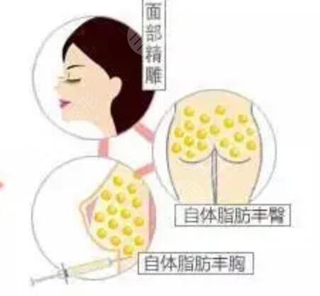 成都玉之光自體脂肪填充面部案例