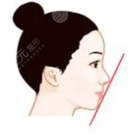 鼻翼縮小術(shù)后果對(duì)比圖