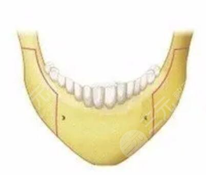 年前做的大腿吸脂塑型，現(xiàn)在有點(diǎn)后悔做腰部的吸脂
