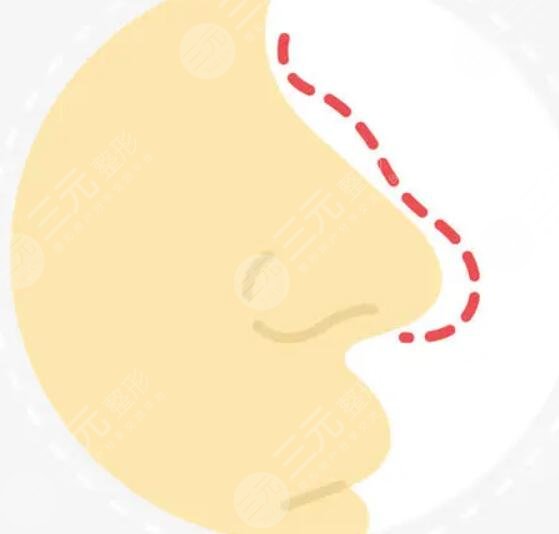 真人案例圖來(lái)嘍，看看隆鼻手術(shù)1-7天分別是什么樣子？