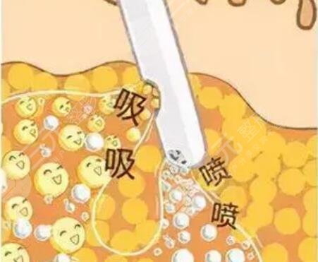 腰部環(huán)形吸脂圖片展示，擁有漂亮的小蠻腰！