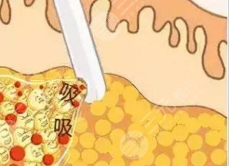 腰部環(huán)形吸脂圖片展示，擁有漂亮的小蠻腰！