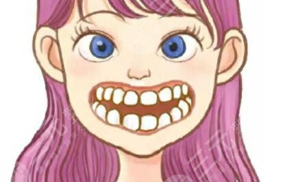 齙牙矯正前后圖片