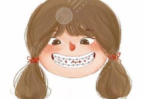 齙牙矯正前后圖片