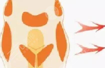 下巴打玻尿酸的后遺癥有哪些？真實案例果反饋