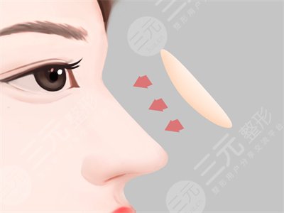 耳軟骨墊鼻尖恢復(fù)過(guò)程圖：8個(gè)月果參考一下！