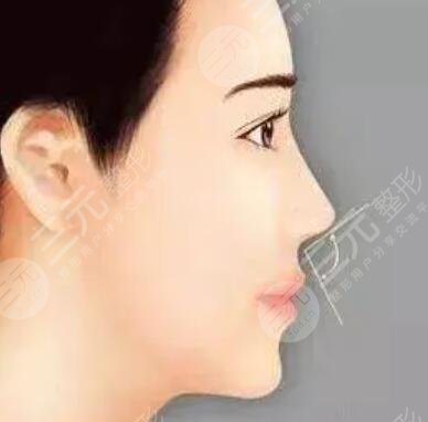 小翹鼻子整形圖片：8個(gè)月的韓式小翹鼻誕生日記~