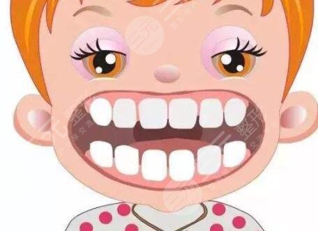 美容冠矯正齙牙