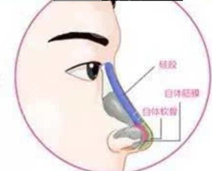 隆鼻前后對比果圖片術(shù)前