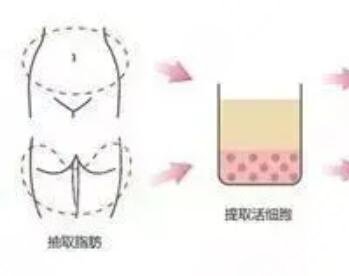 緊縮手術(shù),果圖片