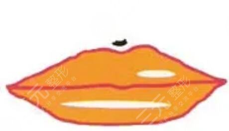 紋唇