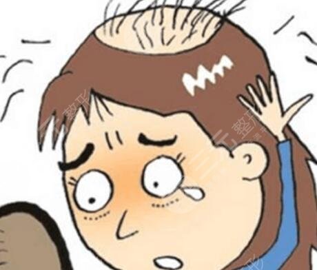 植發(fā)500個(gè)單位能有多大面積呢？看看真人案例圖！