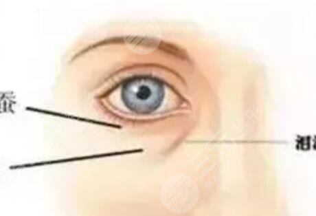 去眼袋果怎么樣？看一下眼袋手術1-10天圖片