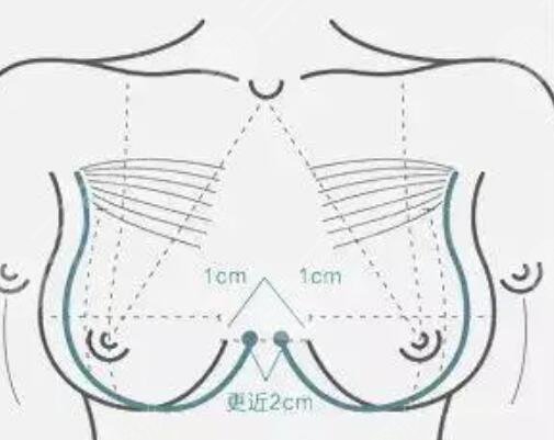 副乳切除后痊愈的幾率高嗎？真人案例果展示~