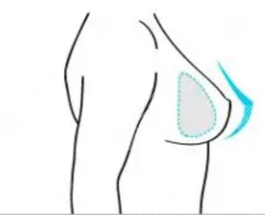 副乳切除后痊愈的幾率高嗎？真人案例果展示~